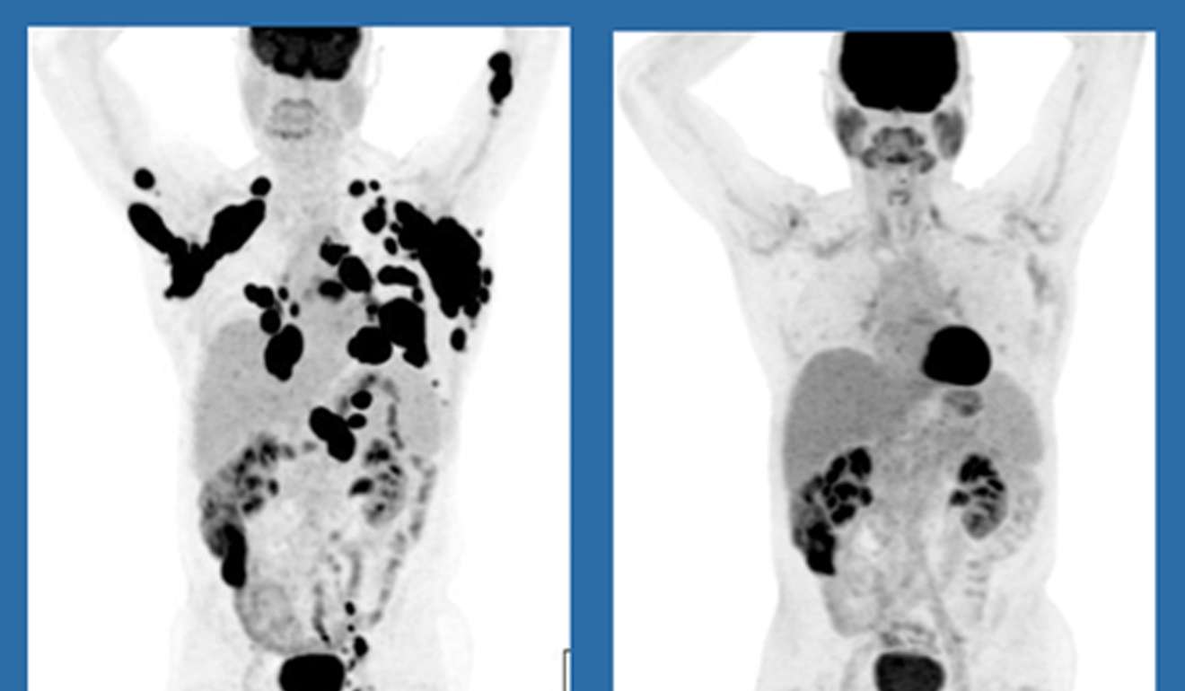 These scans show a 62-year-old man with non-Hodgkin lymphoma at left in December 2015 and three months after treatment with experimental gene therapy at MD Anderson Cancer Centre in Houston. Photo: AP