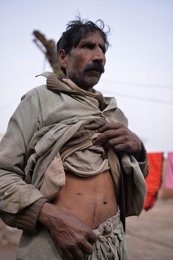 Maqsood Ahmed shows the scar where his kidney was removed. Photo: AFP