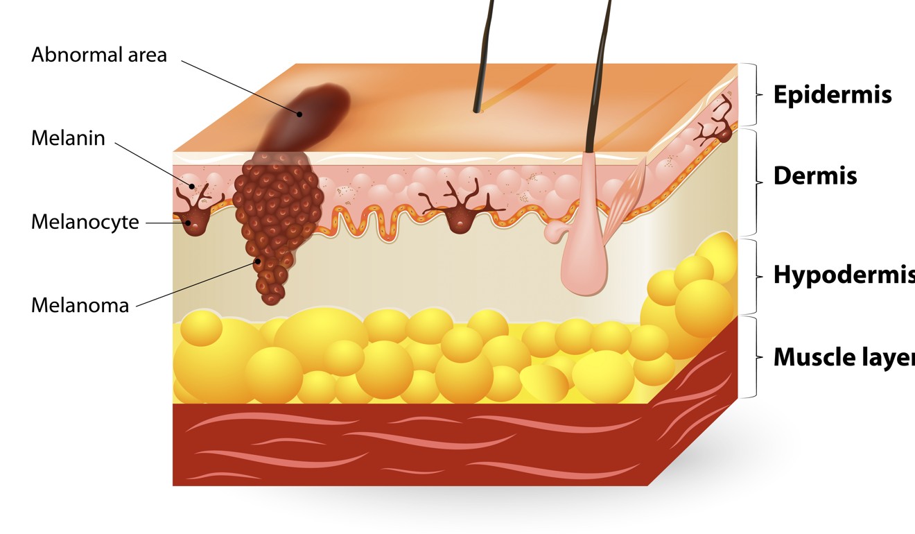 How melanoma attacks the body. Photo: Shutterstock