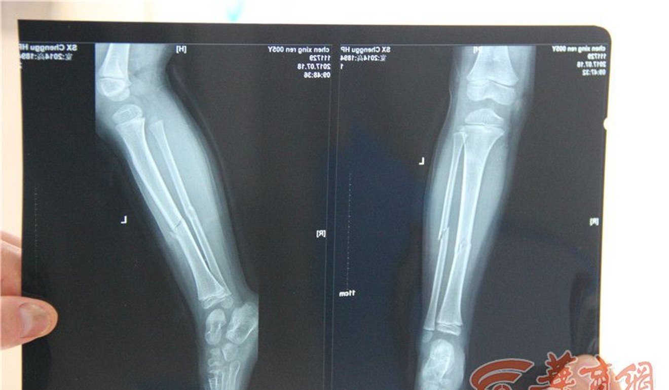 These X-ray images show the fracture to the child’s left leg. Photo: Handout