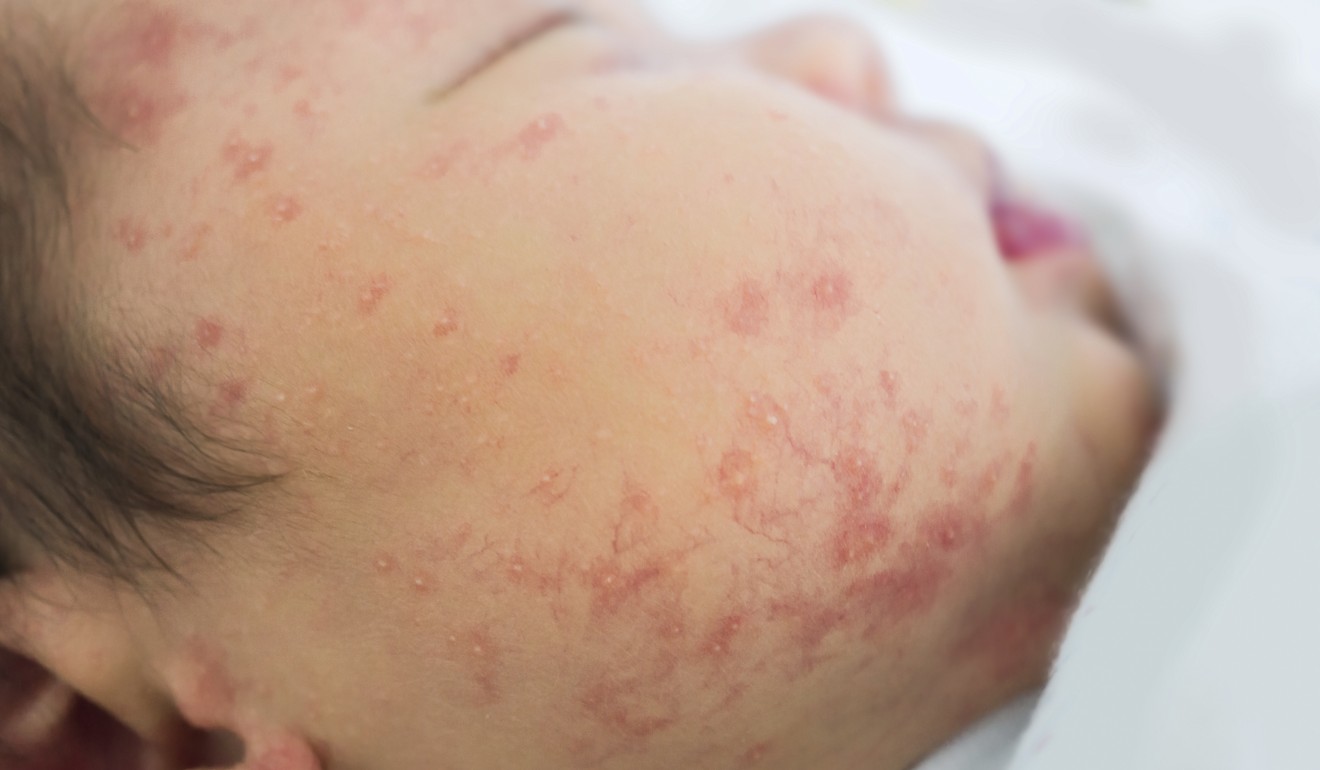 A newborn with an allergic rash. The test Seattle scientists used in their experiments could be used to detect, and possibly cure, allergies in very young children. Photo: Shutterstock