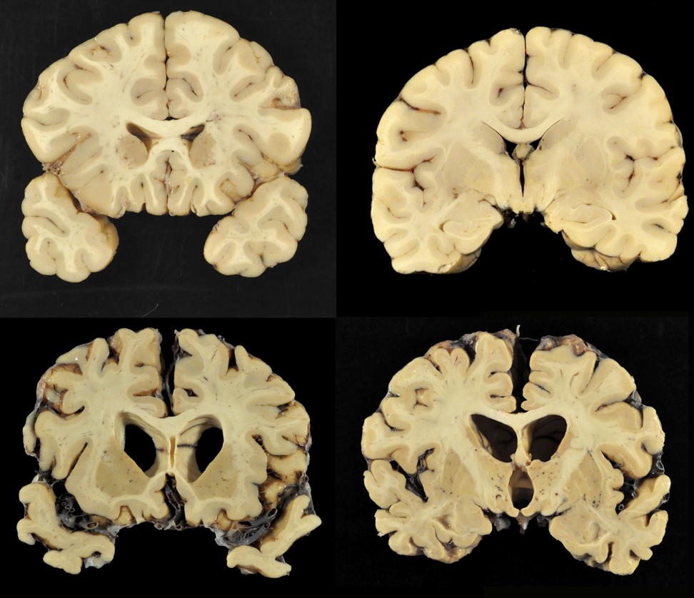 This combination of photos provided by Boston University shows sections from a normal brain, top, and from the brain of former University of Texas football player Greg Ploetz, bottom, in stage IV of chronic traumatic encephalopathy. Photo: AP