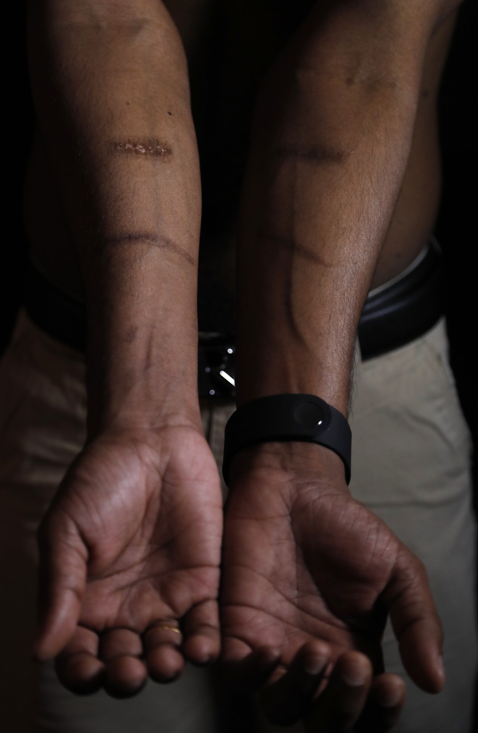 One of the dozens of men, who claimed to be tortured in Sri Lankan government detention, shows his scars. Photo: AP