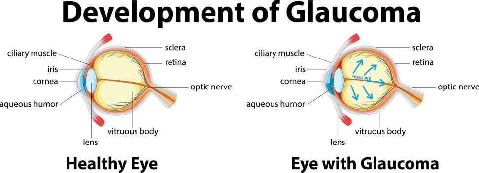 Development of glaucoma in human eyes. Photo: Alamy