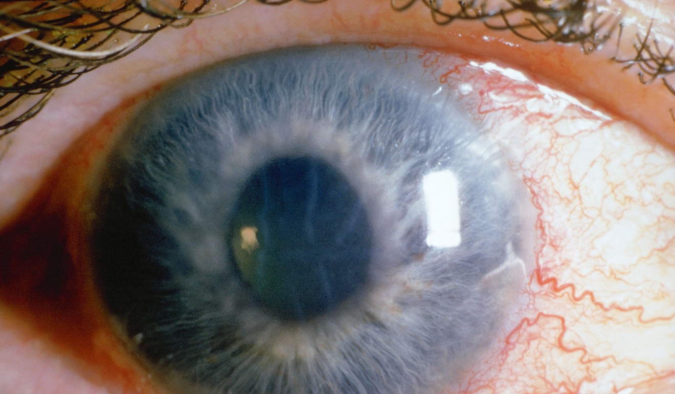 Glaucoma is a group of diseases that involve degeneration of the optic nerve.