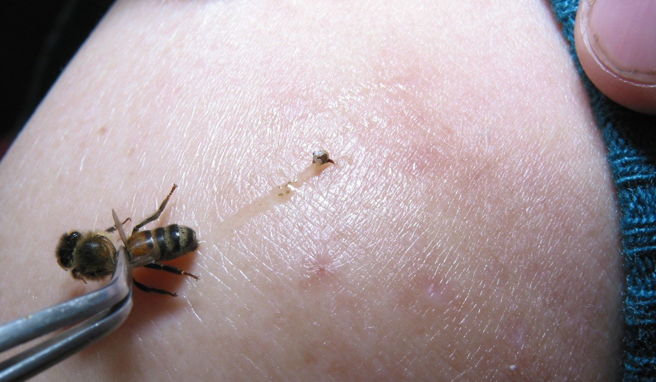 A bee is removed from a patient, leaving its sting behind, during a bee-sting acupuncture session in this file photo. Photo: SCMP