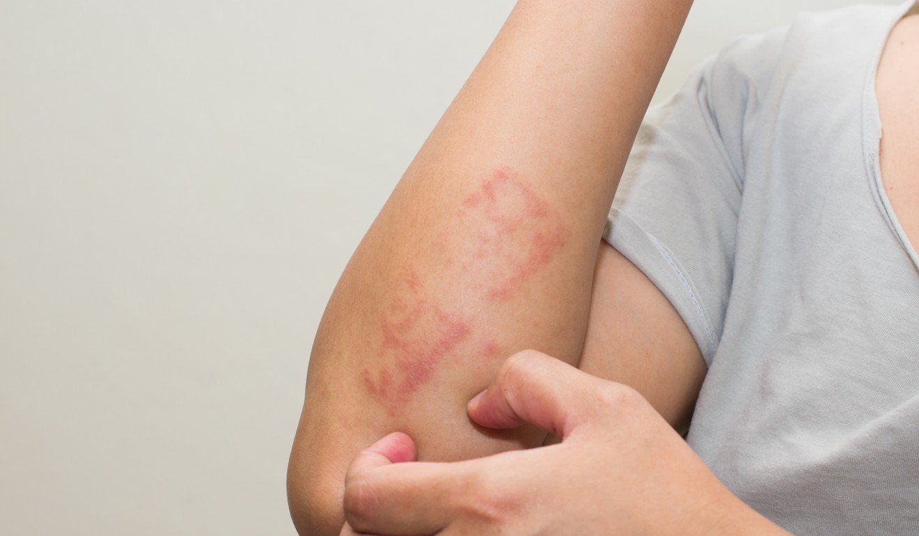 Mild skin irritation from eczema can be treated with topical creams, while more serious cases require oral consumption of steroids. Photo: Shutterstock