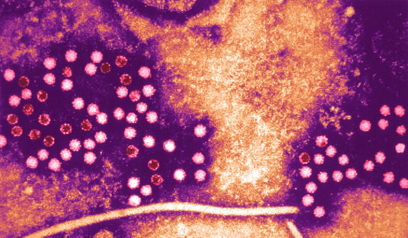 Symptoms of hepatitis E viral infection include fever, reduced appetite, abdominal pain and jaundice. In rare cases, it could lead to acute liver failure and death. Photo: Alamy