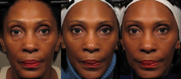 A woman before, during and after the facial exercise study at Northwestern University. Photo: Northwestern University