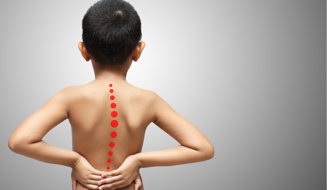 Scoliosis, a sideways curvature of the spine, is a medical condition that often affects children just before puberty. Photo: Shutterstock