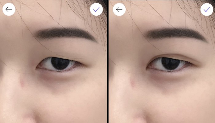 Why Double Eyelid Surgery Is On The Rise In Asia Rising Incomes And Acceptance And Star Power Of Fan Bingbing Angelababy South China Morning Post
